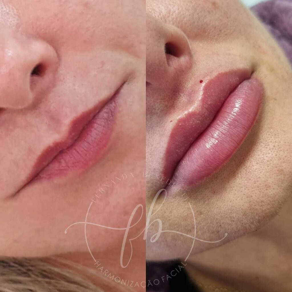 Preenchimento Labial