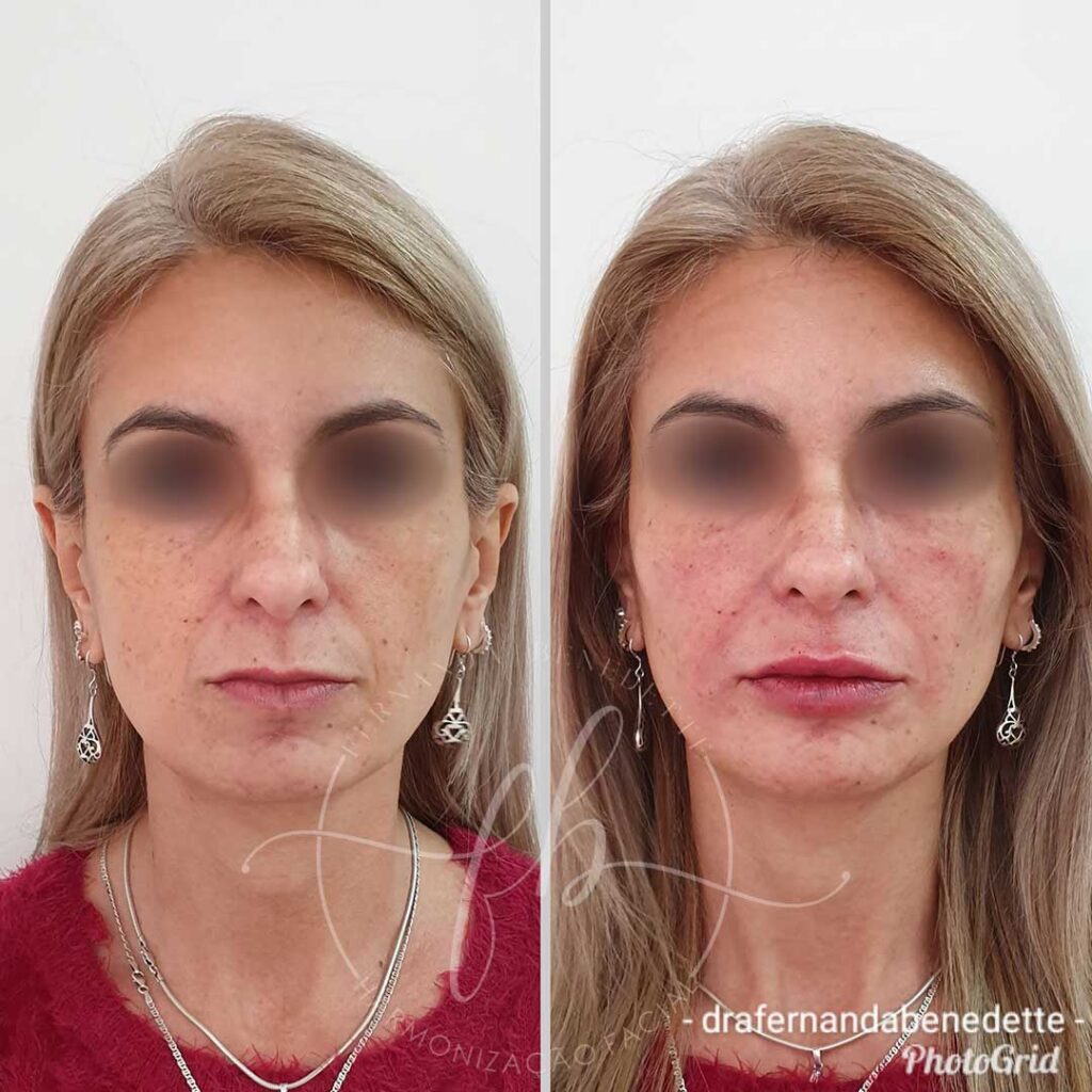 Preenchimento Facial   Dra Fernanda Benedette