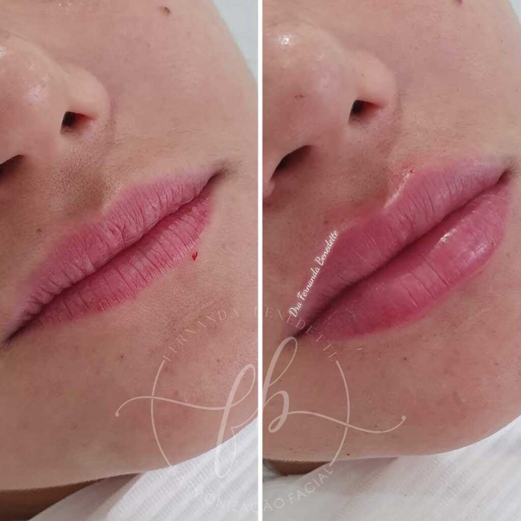 Preenchimento Labial